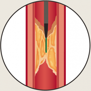 controlled-loose-tissue-tracking