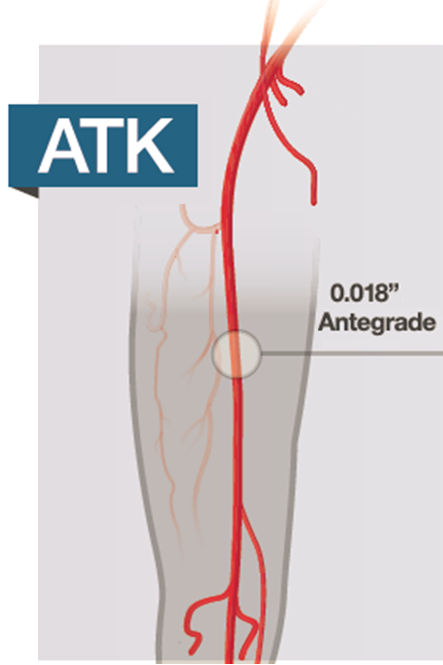 Asahi Peripheral Leg – Top Ny